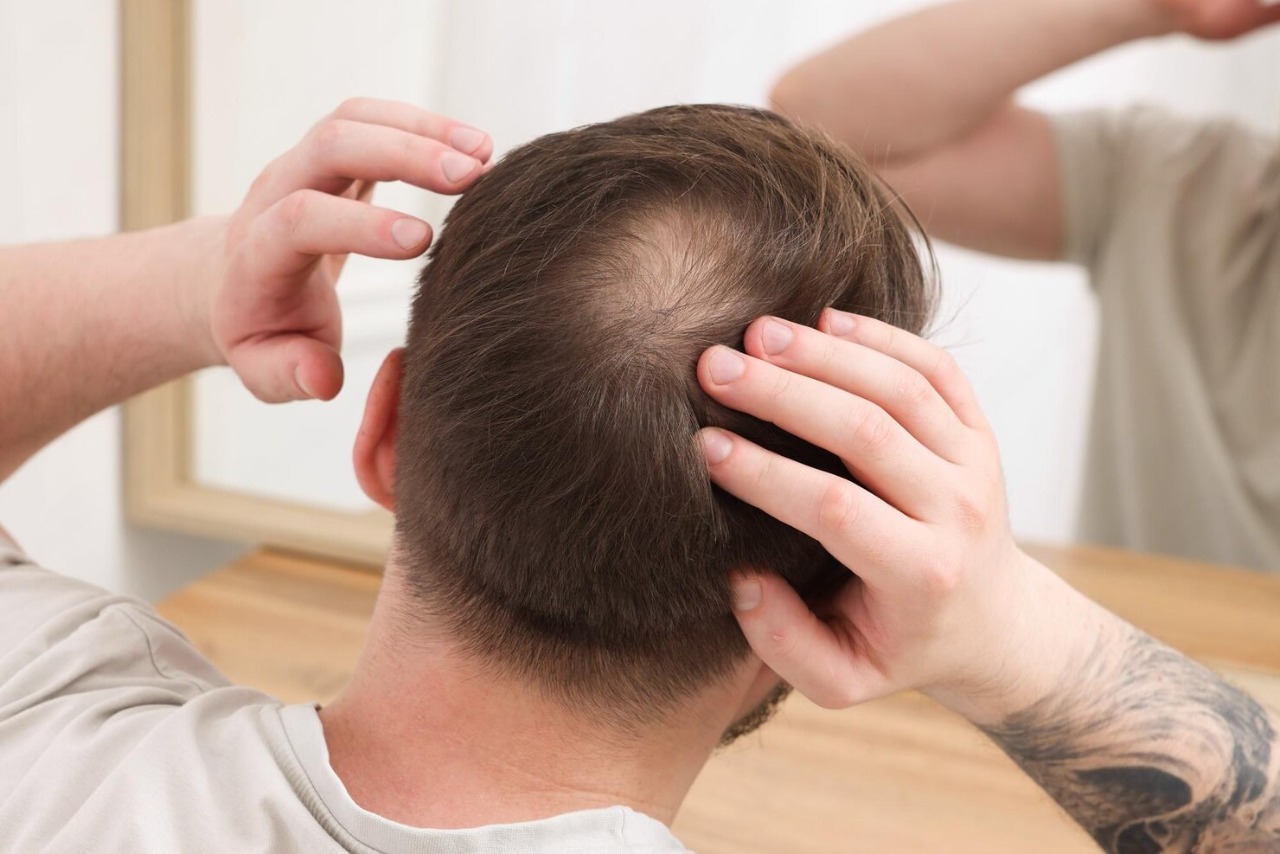 Baldness treatment results showing hair regrowth